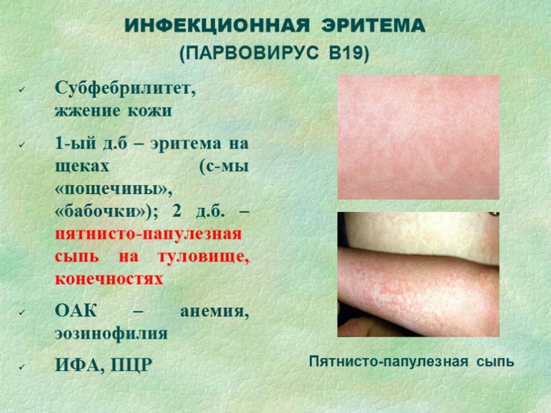 Вирусная пузырчатка – б-нь «рука-нога-рот» ЭНТЕРОВИРУСНАЯ ИНФЕКЦИЯ  Фебрильная лихорадка 3-4 дн.  