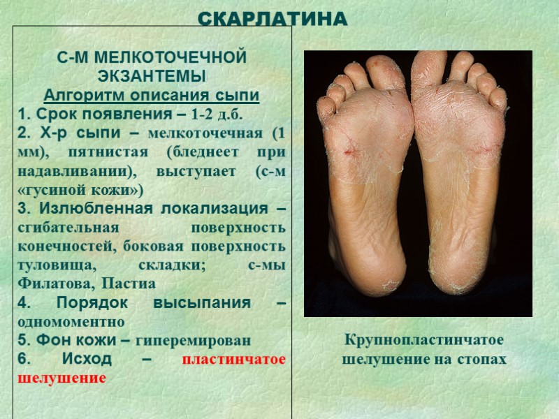 С-М МЕЛКОТОЧЕЧНОЙ  ЭКЗАНТЕМЫ Алгоритм описания сыпи 1. Срок появления – 1-2 д.б. 2.