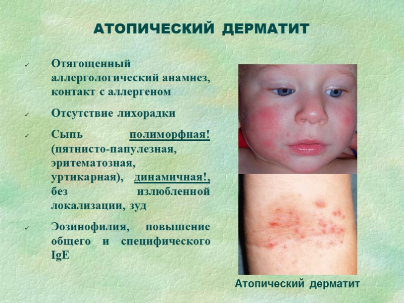 Субфебрилитет, жжение кожи  1-ый д.б – эритема на щеках (с-мы «пощечины», «бабочки»); 2