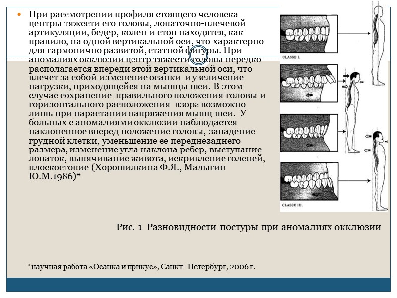 Под дистальным прикусом понимают заднее положение нижнего зубного ряда по отношению к верхнему, при