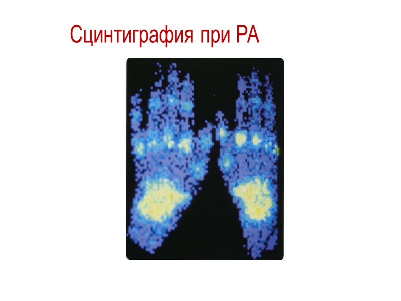 Ревматоидный артрит – рентгенологическая диагностика Поражение типичных для РА суставов  в первые годы