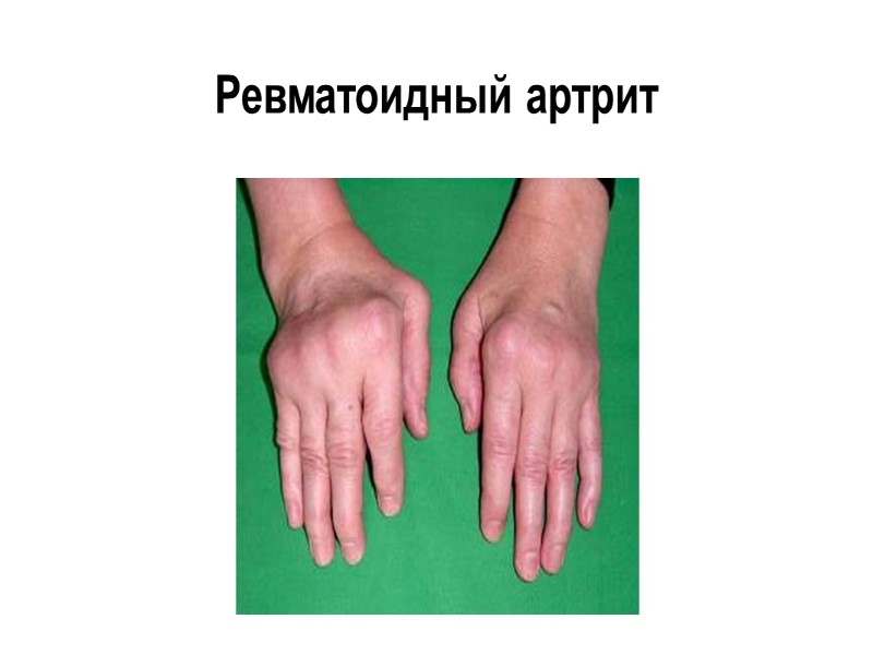 Ранний агрессивный артрит (дорсальное поперечное сканирование) допплеровский сигнал тесно прилежит к костному краю (A).