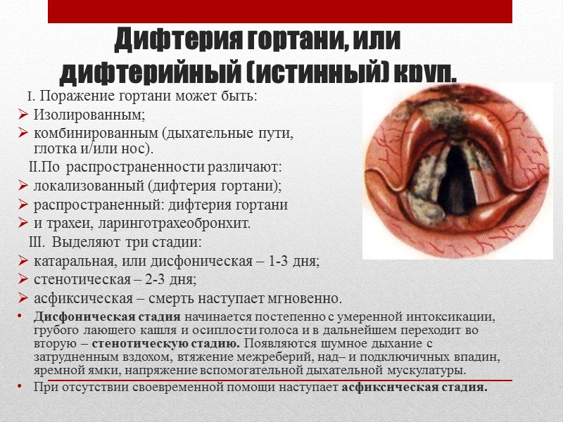 Дифтерия(diphteria)  – острое инфекционное заболевание, вызываемое токсигенными коринебактериями, которое характеризуется фибринозным воспалением в