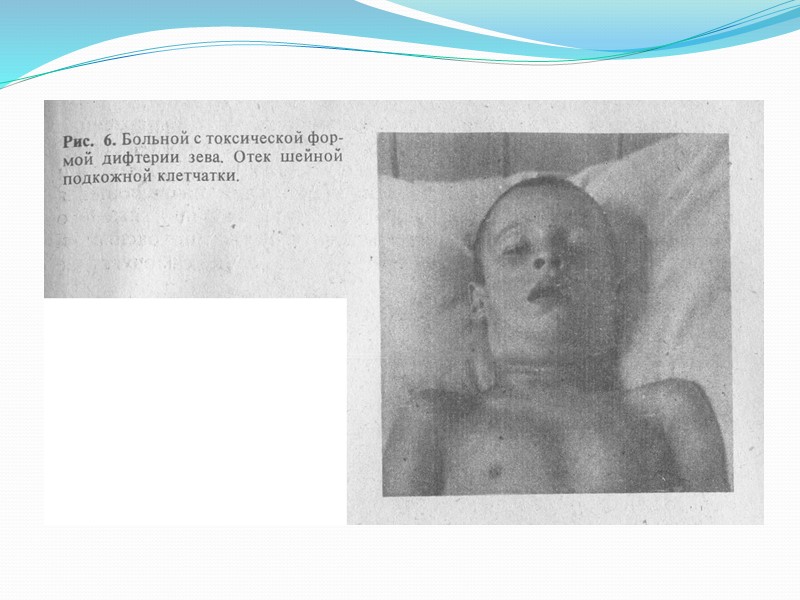 Дифтерия Дифтерия у детей — это острое инфекционное заболевание, характеризующееся воспалением слизистых оболочек верхних
