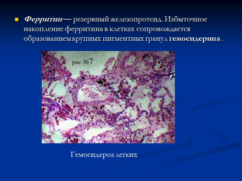 Стромально-сосудистые диспротеинозы Сущность их заключается в патологическом синтезе белков клетками мезенхимального происхождения, в дезорганизации
