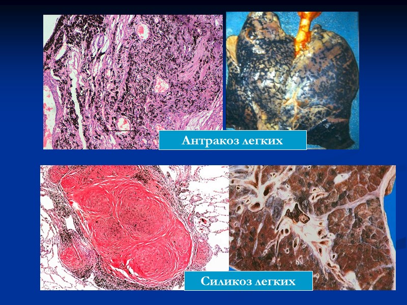 Силикоз. Антракоз силикоз легкого микропрепарат. Силикоз патологическая анатомия. Пневмокониозы патологическая анатомия.