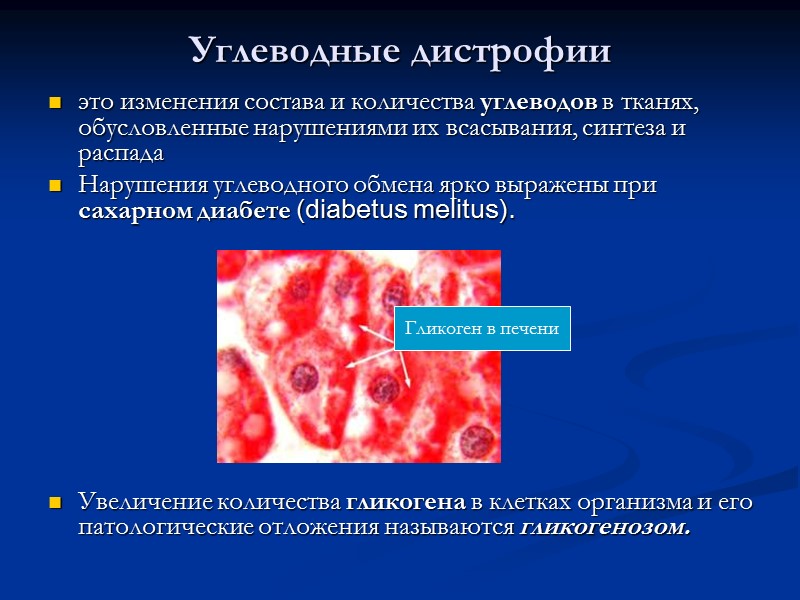 Антракоз легких Силикоз легких