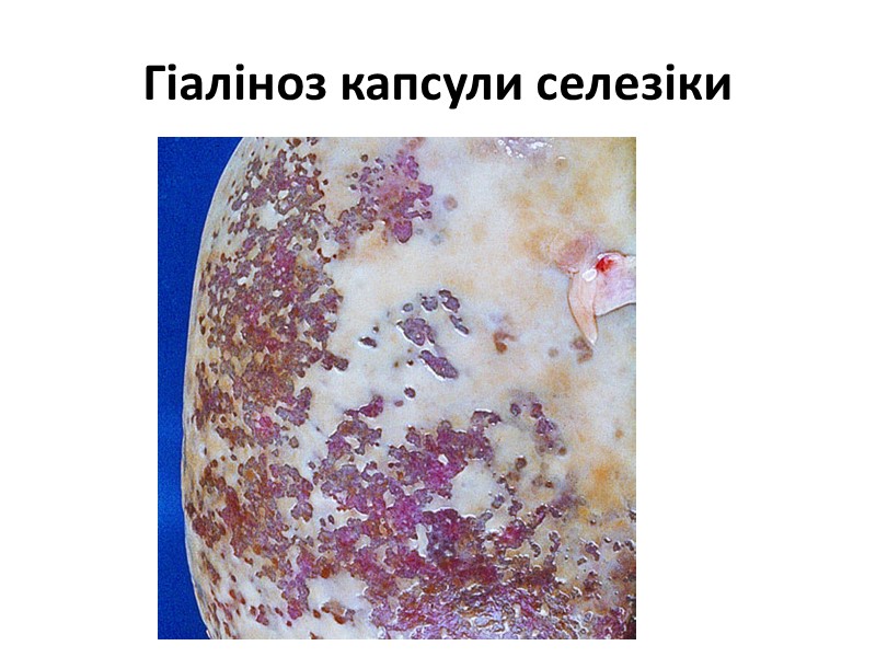 Гіаліноз судин ниркового клубочка