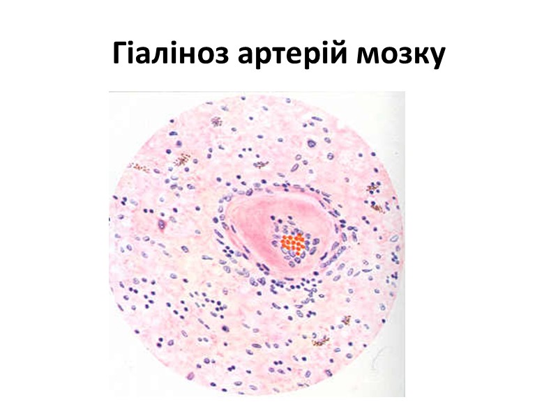 Гіаліноз мілкої артерії мозку