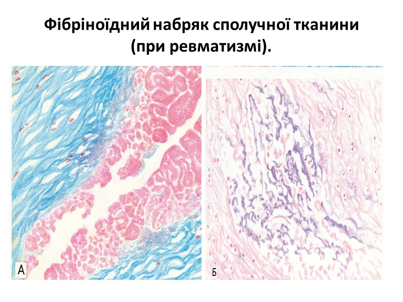 Гіаліноз артерій мозку