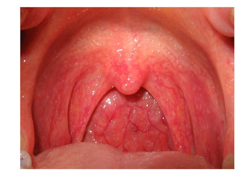 ПОД ВОЗДЕЙСТВИЕМ НЕЙРОТОКСИНА  В  МЕСТЕ ВХОДНЫХ ВОРОТ ВОЗНИКАЕТ НЕКРОЗ ПОВЕРХНОСТНОГО ЭПИТЕЛИЯ 