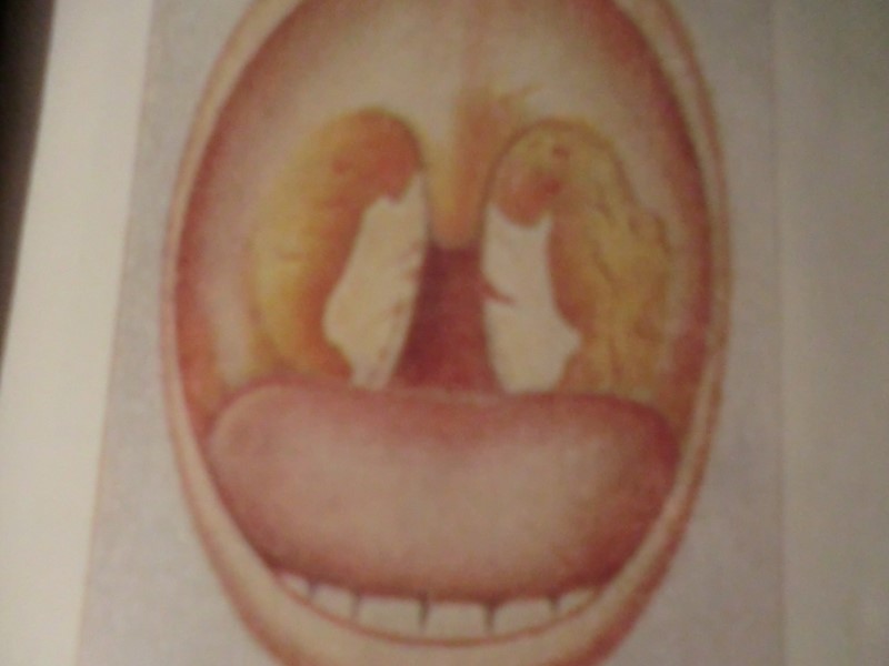ФИБРИНОГЕН СОДЕРЖАЩИЙСЯ  В ПЛАЗМЕ ПРИ КОНТАКТЕ С ТРОМБОПЛАСТИНОМ НЕКРОТИЗИРОВАННОГО ЭПИТЕЛИЯ ПЕРЕХОДИТ В ФИБРИН