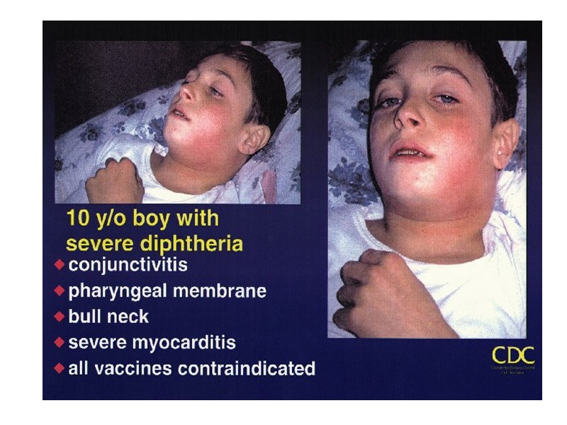 НА СЛИЗИСТОЙ С ОДНОСЛОЙНЫМ ЭПИТЕЛИЕМ –ГОРТАНЬ ТРАХЕЯ БРОНХИ –РАЗВИВАЕТСЯ КРУПОЗНОЕ ВОСПАЛЕНИЕ  ПРИ КОТОРОМ