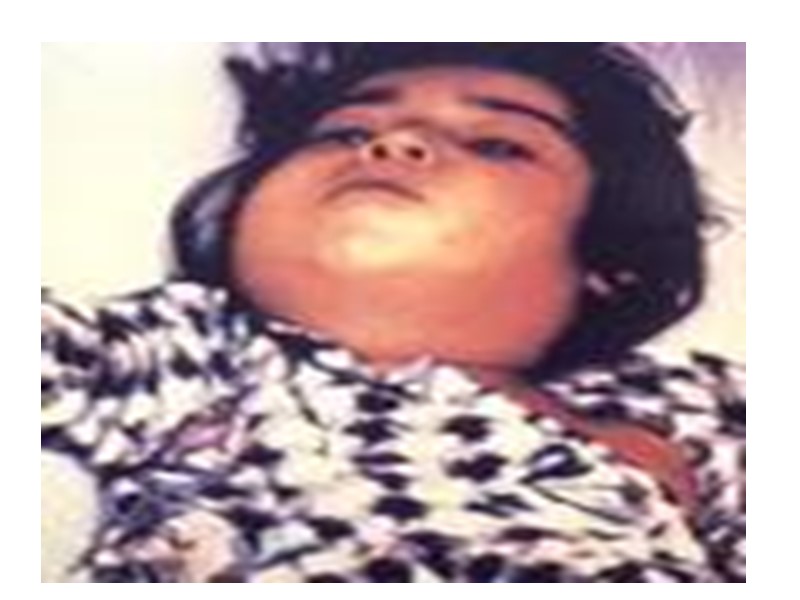 ВТОРАЯ ФРАКЦИЯ ДИФТЕРИЙНОГО ТОКСИНА-ИСТИННЫЙ ТОКСИН ПО СВОЕЙ СТРУКТУРЕ ПОХОЖ НА ЦИТОХРОМ Б-ФЕРМЕНТ УЧАСТВУЮЩИЙ В