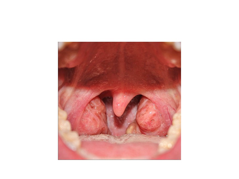 В стационаре проводится комплексная терапия направленная на нейтрализацию дифтерийного токсина.Доза антитоксической противодифтерийной сыворотки индивидуальна