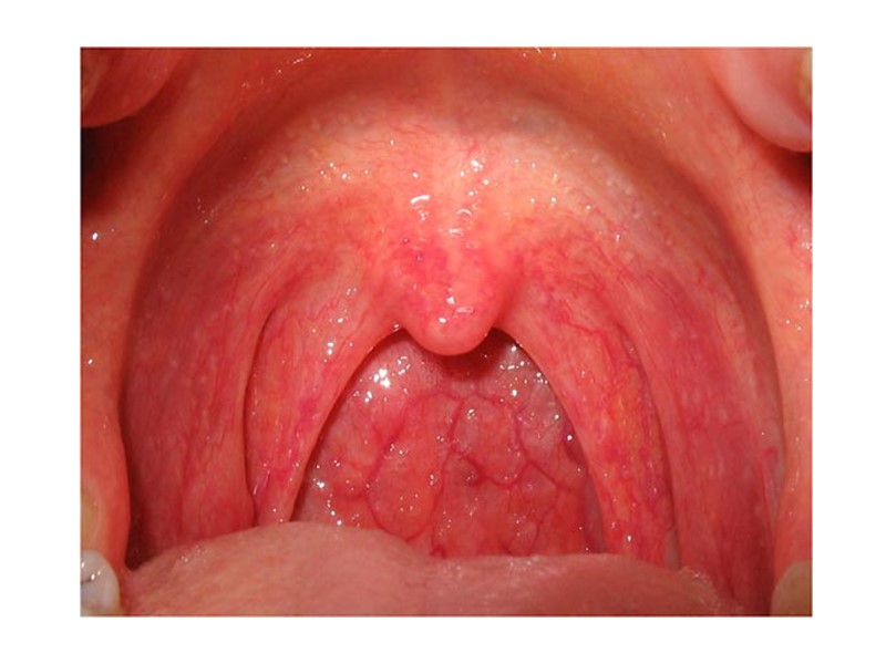 Температурная реакция и налеты держатся долго до 10 и более дней налеты не изменяются