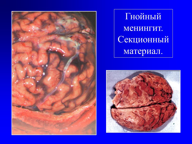 Классификация бактериальных менингитов(продолжение)  5. По характеру течения: - молниеносное - острое (до 4-х