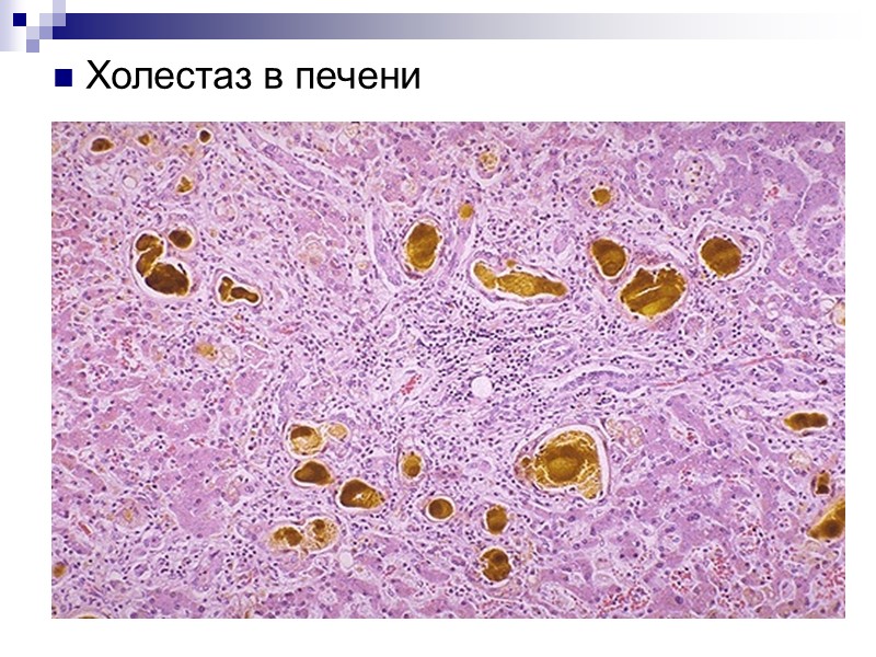 Печеночная (печеночно-клеточная, паренхиматозная) желтуха возникает при повреждении гепатоцитов (дистрофия, некроз), в результате нарушается захват,