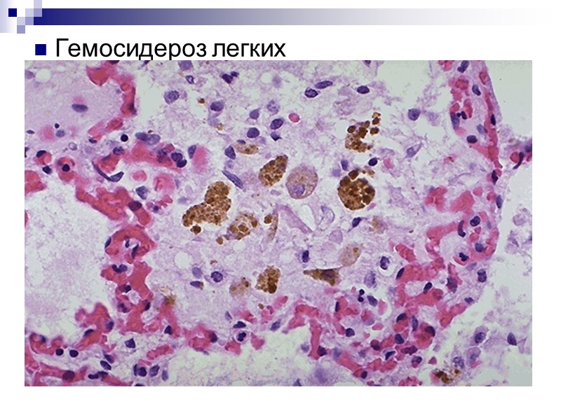 НАРУШЕНИЯ ОБМЕНА ГЕМОГЛОБИНОГЕННЫХ ПИГМЕНТОВ Гемоглобин (высокомолекулярный хромопротеид) – железосодержащий дыхательный пигмент, составляющий основу эритроцитов