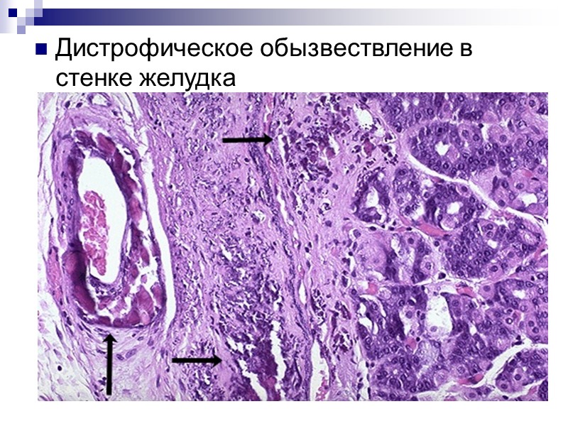 Примеры.  Некротизированные ткани организма (казеозный некроз в гранулемах (при туберкулезе, сифилисе)  Тромбы.