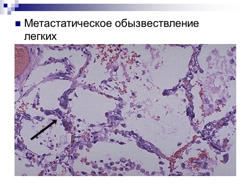 Метаболическое обызвествление (интерстициальный кальциноз). Механизм его развития до конца не ясен. Главное значение придают