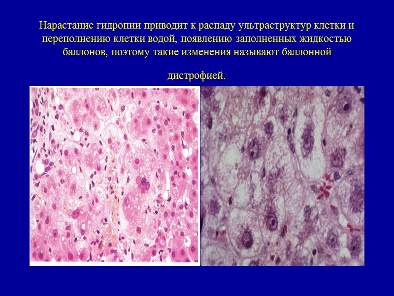 Гидропическая дистрофия Макро: наблюдается в эпителии кожи и почечных канальцев, в гепатоцитах, мышечных и