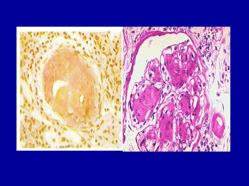 Распространенный гиалиноз Гиалиноз сосудов возникает чаще в исходе плазморрагии или фибриноидного набухания при гипертонической
