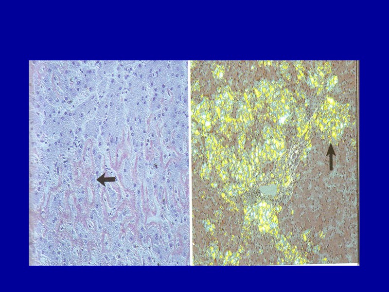 Амилоидоз печени В печени отложение амилоида наблюдается между звездчатыми ретикулоэндотелиоцитами синусоидов, по ходу ретикулярной