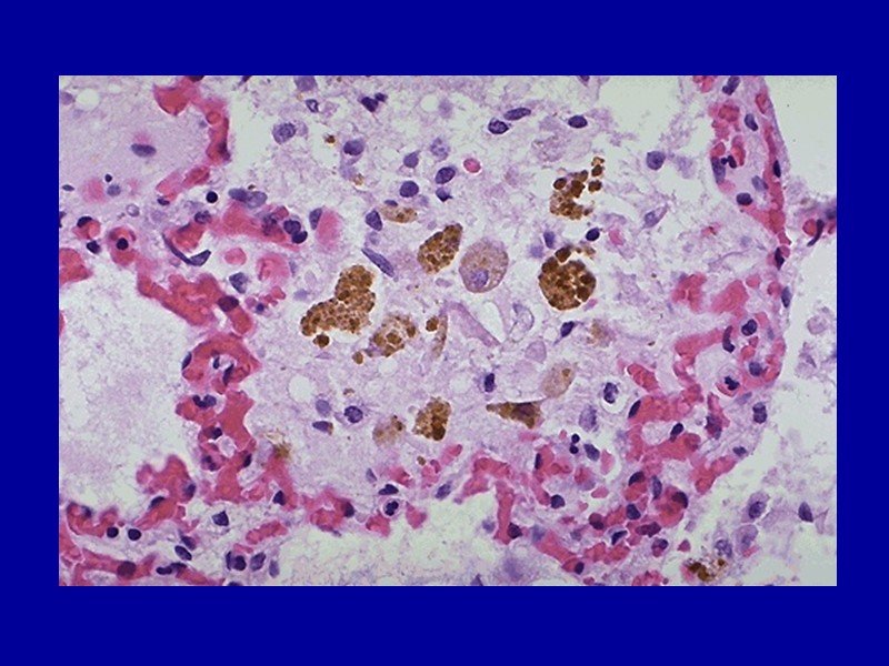 Билирубин. Основной пигмент желчи. Образуется в клетке при разрушении гемоглобина, железа не содержит. В