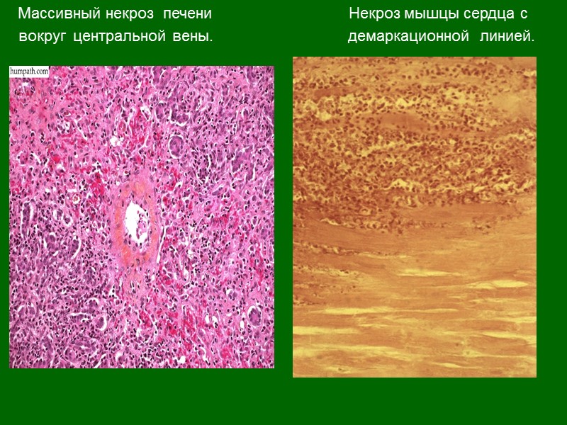 Микроскопические изменения в клетках. Острый массивный некроз печени. Центролобулярный некроз гепатоцитов.