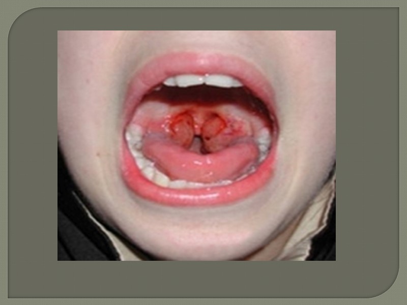 Дифтерия (diphtheria; греч. diphthera кожа, пленка) - инфекционная болезнь, при которой в результате действия