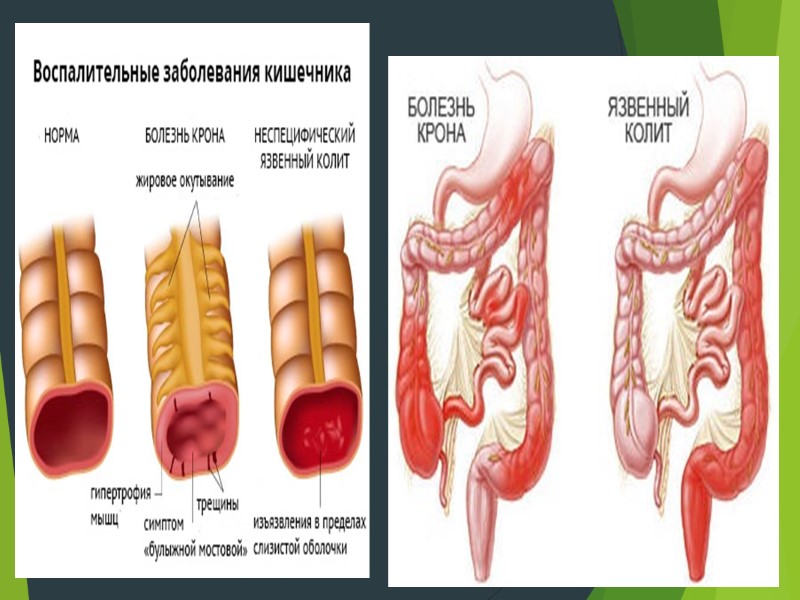 Осложнения БК со стороны желудочно- кишечного тракта Абдоминальный инфильтрат; Межкишечные и кишечно-кожные свищи; 