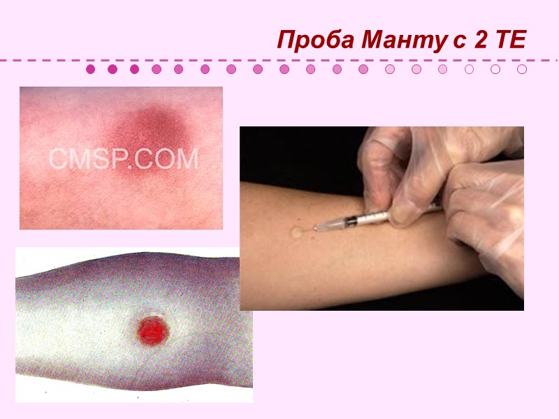 Патогенез и клинические особенности Первичный туберкулезный комплекс: первичный аффект; лимфангоит; лимфаденит. Первичный очаг окружается