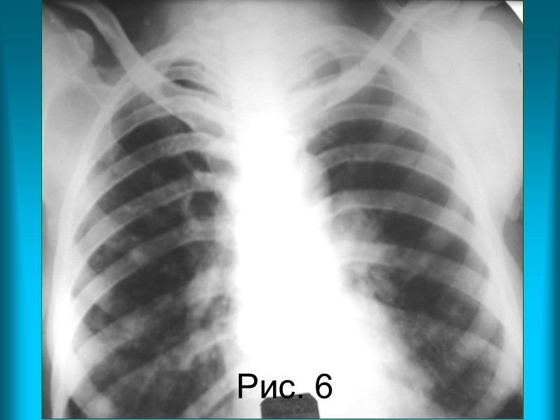 Н.С. Воротынцева. С.С. Гольев  Рентгенопульмонология Пациент С. 59л. Диагноз: Периферический бронхиолоальвеолярный рак, диссеминированная