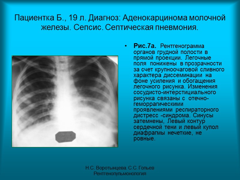 Н.С. Воротынцева. С.С. Гольев  Рентгенопульмонология Рис.4б. Рентгенограмма органов грудной полости в прямой проекции.