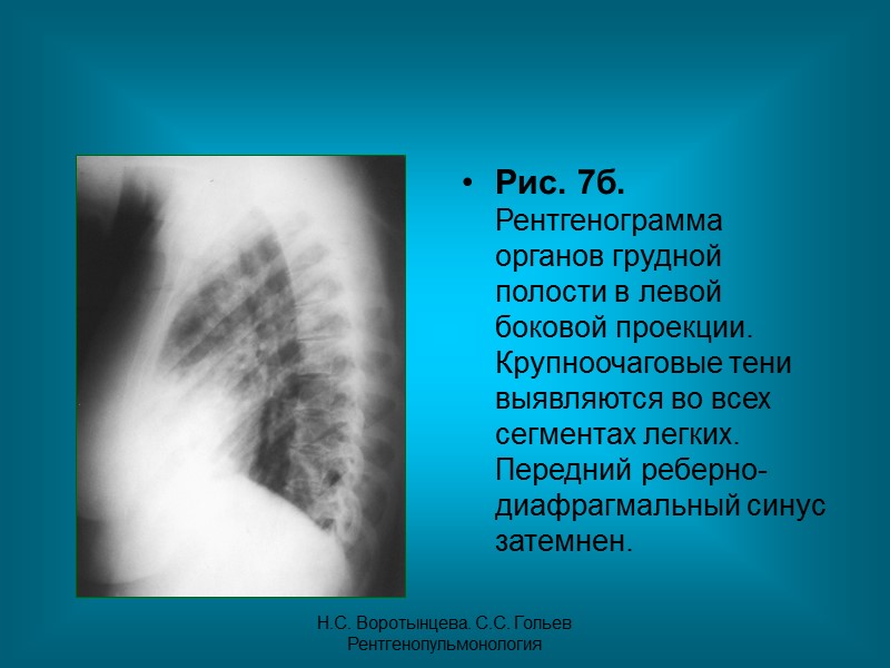Н.С. Воротынцева. С.С. Гольев  Рентгенопульмонология Рис. 4в. Томограмма органов грудной полости в прямой