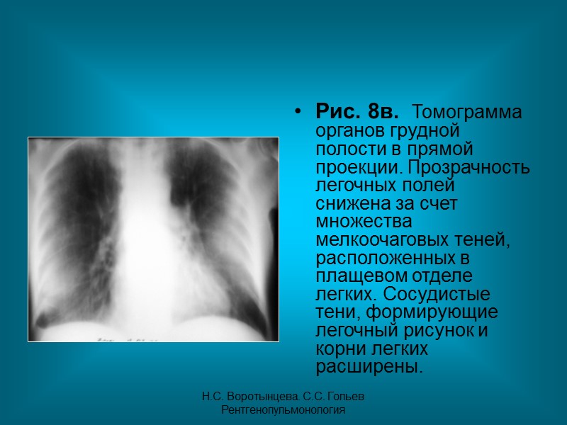 Н.С. Воротынцева. С.С. Гольев  Рентгенопульмонология Рис.5в.  Контрастное исследование бронхиального дерева левого легкого
