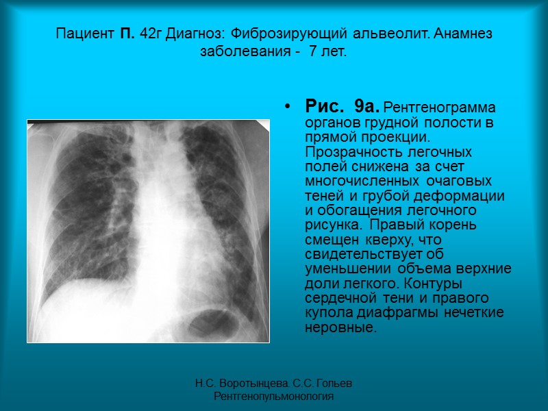 Н.С. Воротынцева. С.С. Гольев  Рентгенопульмонология Рис. 5г. Контрастное исследование бронхиального дерева левого легкого