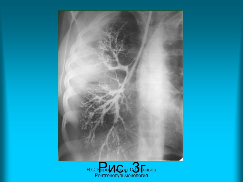 Н.С. Воротынцева. С.С. Гольев  Рентгенопульмонология Пациентка К. 70 л. Диагноз: Диссеминированный туберкулез легких.
