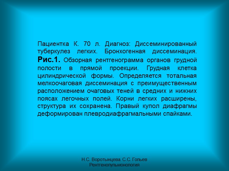Н.С. Воротынцева. С.С. Гольев  Рентгенопульмонология Рис. 7б.  Рентгенограмма органов грудной полости в