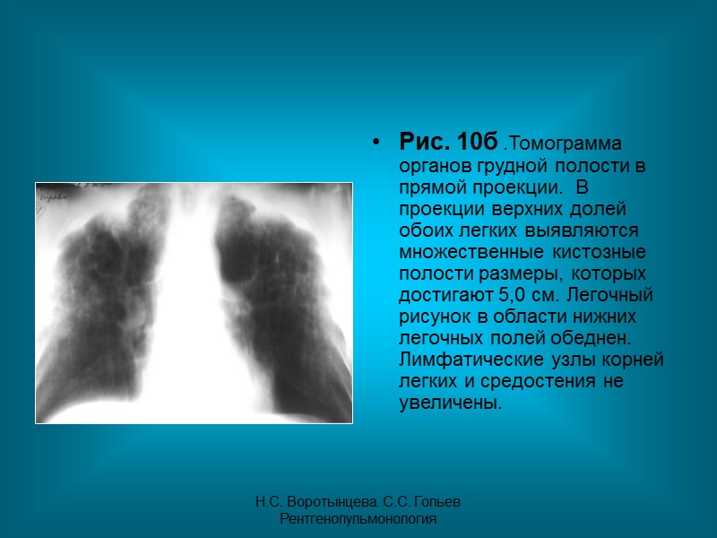 Н.С. Воротынцева. С.С. Гольев  Рентгенопульмонология Рис.8б.  Рентгенограмма органов грудной полости в правой