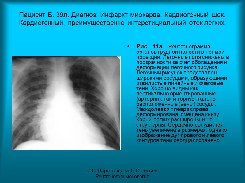 Н.С. Воротынцева. С.С. Гольев  Рентгенопульмонология Рис. 8в.  Томограмма органов грудной полости в