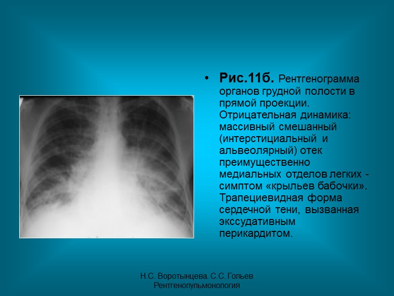 Н.С. Воротынцева. С.С. Гольев  Рентгенопульмонология Пациент П. 42г Диагноз: Фиброзирующий альвеолит. Анамнез заболевания