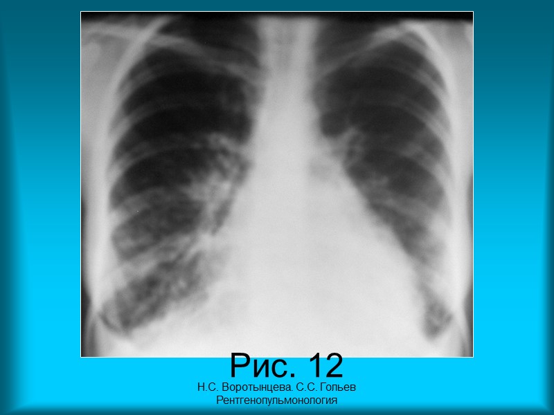 Н.С. Воротынцева. С.С. Гольев  Рентгенопульмонология Рис. 9 в. Рентгенограмма органов грудной полости в