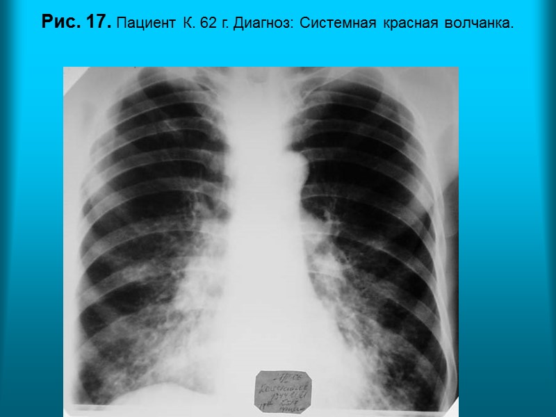 Н.С. Воротынцева. С.С. Гольев  Рентгенопульмонология Пациентка Б. 28 л.  Диагноз: Системная красная