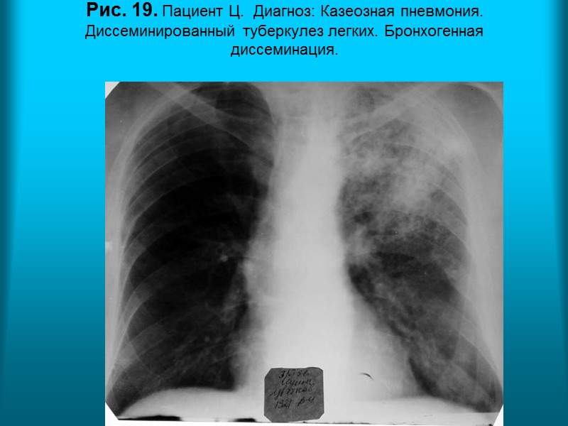 Н.С. Воротынцева. С.С. Гольев  Рентгенопульмонология Рис. 15.Пациентка П. 45л. Диагноз: Системная красная волчанка.