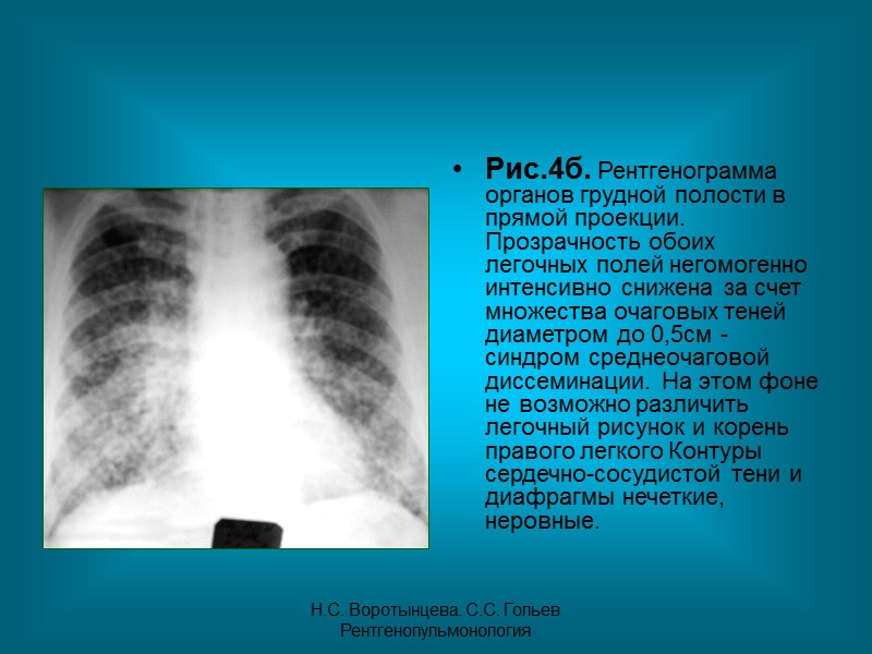 Н.С. Воротынцева. С.С. Гольев  Рентгенопульмонология Пациентка З. 55л. Диагноз: Подострый диссеминированный туберкулез легких,