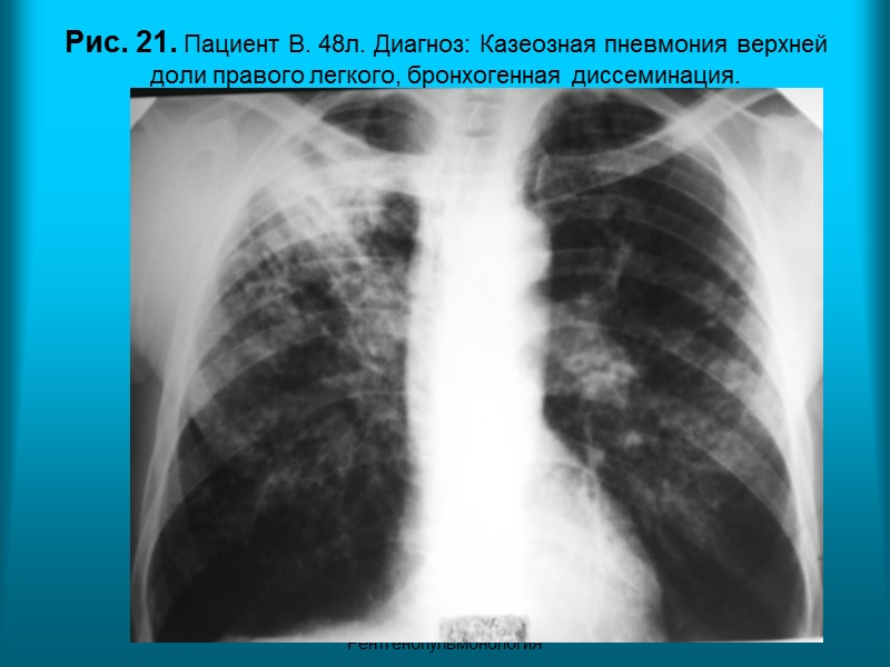 Н.С. Воротынцева. С.С. Гольев  Рентгенопульмонология Рис. 17. Пациент К. 62 г. Диагноз: Системная