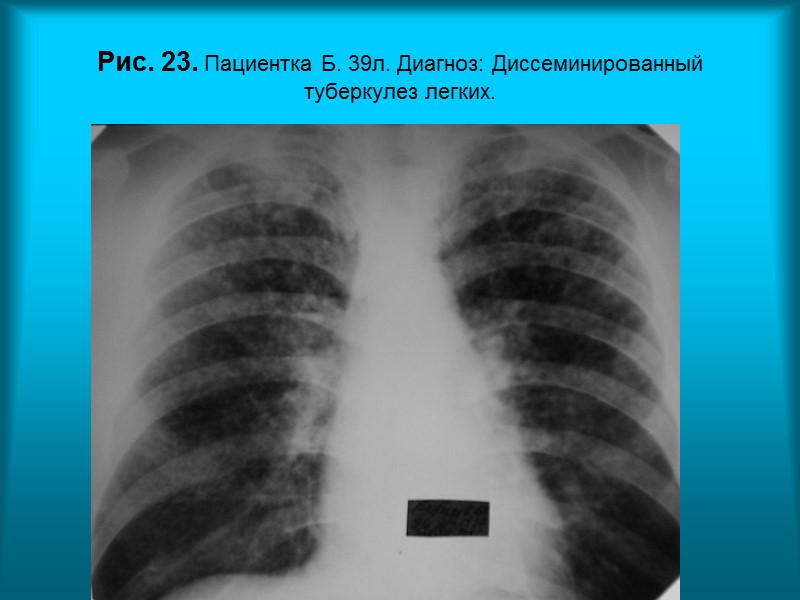Н.С. Воротынцева. С.С. Гольев  Рентгенопульмонология Клинические варианты сочетания легочных синдромов.