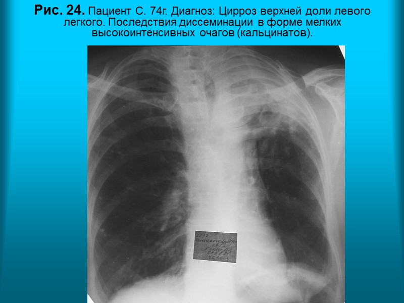 Н.С. Воротынцева. С.С. Гольев  Рентгенопульмонология Рис.  20. Пациент З. 45 л. Диагноз: